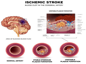 谨防复发风险！缺血性卒中后不宜提早停用他汀