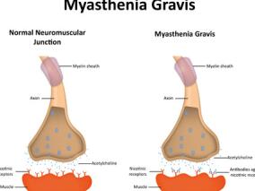 利妥昔单抗或对抗MuSK重症肌无力患者结局有利