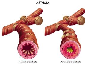 吉宁飞教授：哮喘药物的研发和临床应用进展