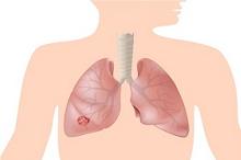 广泛期小细胞肺癌患者一线治疗 哪家强？