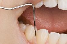 MetS合并重度牙周炎患者：牙周治疗有益于心