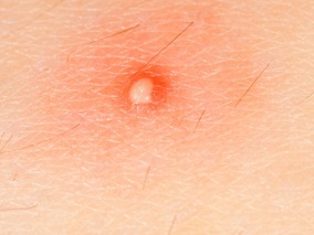 65岁男子胸背皮肤疼痛伴丘疹、水疱 原来是急性感染性皮肤病