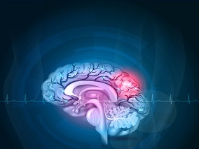 预防慢性腔隙性脑卒中复发 基于西洛他唑的双重抗血小板治疗效果如何？