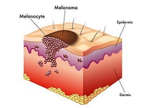 小剂量切口抗生素对皮肤癌手术部位感染率有何影响？