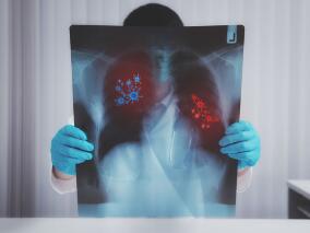 吸入性肺炎该不该扩大厌氧抗生素覆盖率？这一研究或带来答案