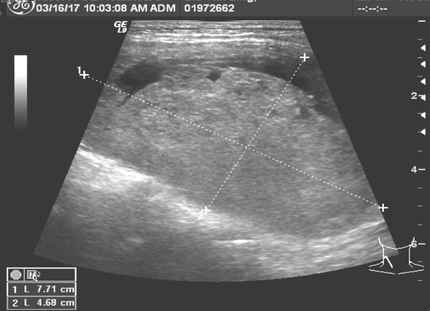 胸内甲状腺肿合并甲状腺乳头状癌一例