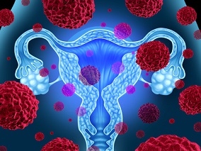 FDA批准度伐利尤单抗用于治疗子宫内膜癌